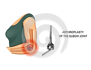 Endoprosthesis of the elbow joint