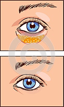 Vector illustration of a eye aesthetic blepharoplasty