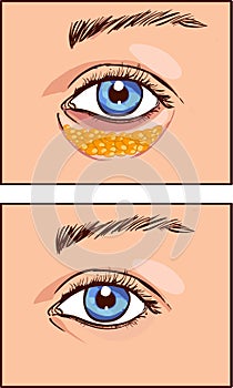 Vector illustration of a eye aesthetic blepharoplasty photo