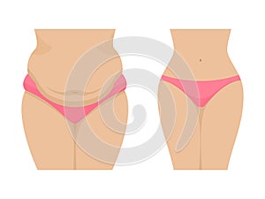 Vector illustration of a fat and thin female belly photo