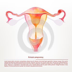 Vector illustration of female genitals, ectopic pregnancy. photo