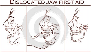 Vector illustration of a first aid dislocated Jaw