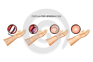 Fistula for hemodialysis. suturing of vein and artery photo