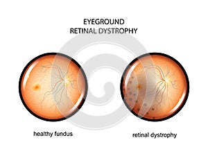 Eyeground. retinal dystrophy photo