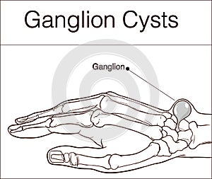 Vector illustration of a Ganglion cyst