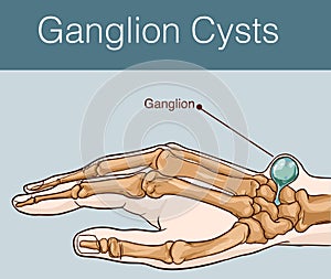 Vector illustration of a Ganglion cyst photo