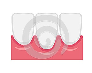 Vector illustration of gingival recession
