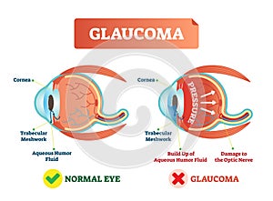 Vector illustration of glaucom. Cross section with damaged eye. Scheme with cornea, trabecular meshwork and aqueous humor fluid.