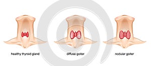 Goiter, thyroid gland