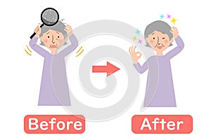 Before-after vector illustration of grandma suffering from dandruff of the scalp