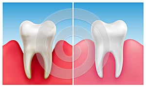 Vector illustration of gum disease -  periodontitis in compare with healthy white tooth