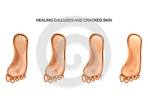 Healing calluses and cracked heels photo