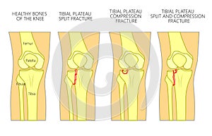 Bone fracture_Tibial plateau fracture photo