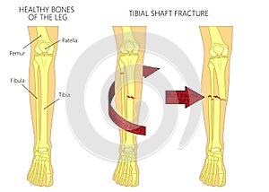 Bone fracture_Tibial shaft fracture photo