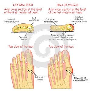 Normal foot and Hallux valgus with rotation of the first mematarsal bone