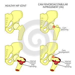 Hip joint problem_Cam femoroacetabular impingement with section photo