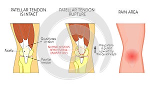 Anatomy_Patellar tendon rupture photo