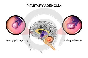 A healthy pituitary and pituitary adenoma photo