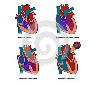 Vector illustration of the heart defects linked to the Down syndrome: septal defects, tetralogy of Fallot and patent ductur photo