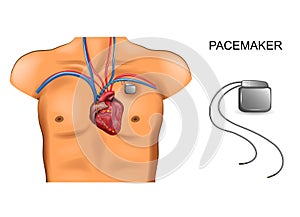 Heart and pacemaker. cardiology