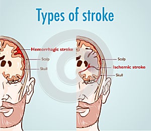 Vector illustration of a Hemorrhagic and ischemic stroke