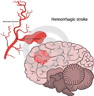 Vector illustration of hemorrhagic stroke.