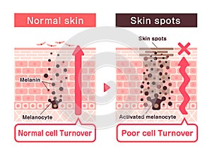 Illustration of how skin spots (hyperpigmentation) are created photo