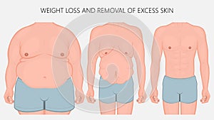 Human body problem_Weight loss and removal of excess skin front photo