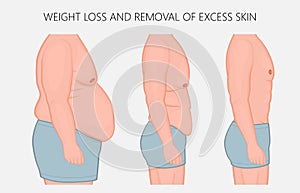 Human body problem_Weight loss and removal of excess skin side v photo