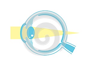 Vector illustration of hyperopia (no text