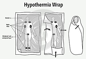 Vector illustration of a hypothermia wrap and first aid