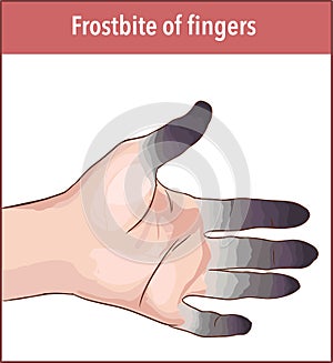 Vector illustration of a hypothermia wrap and first aid