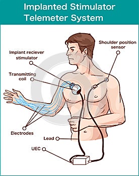 vector illustration of a Implanted stimulator telemeter system