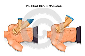 Indirect heart massage options photo