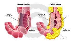 Vector illustration of intestine with Crohns disease