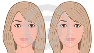 Face front_Jaw asymmetry correctiom surgery Face photo