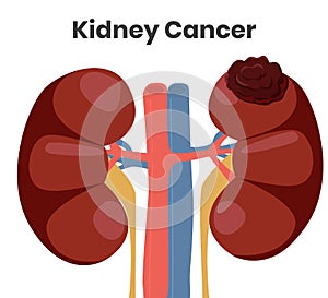 Vector illustration of the kidney cancer. The tumor is affecting left kidney while right kidney is normal