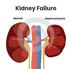 Vector illustration of the kidney failure. Normal kidney versus kidney affected with nephrosclerosis