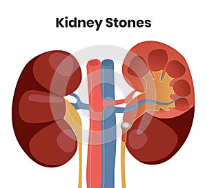 Vector illustration of the kidney stones. Obstruction of the urether with the stone