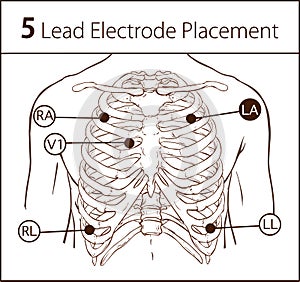 Vector illustration of a 5 lead electrode placement photo
