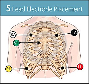 Vector illustration of a 5 lead electrode placement