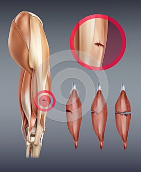 Vector illustration of leg muscle injury with rupture at different stages. Isolated on background