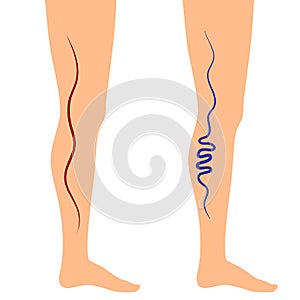 Vector illustration leg veins
