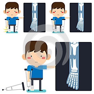 Leg x-ray Tiny cute cartoon patient man character right leg broken in gypsum bandage or plastered leg standing with axillary