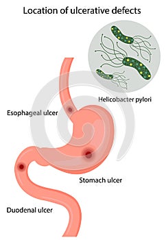 Vector illustration of the location of ulcerative defects