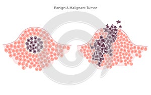 Vector  illustration of malignant and benign tumor