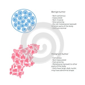 Vector  illustration of malignant and benign tumor
