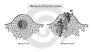 Vector  illustration of malignant and benign tumor