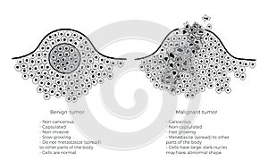 Vector  illustration of malignant and benign tumor