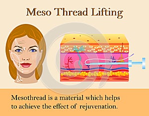 Vector illustration of meso threads lifting isolated photo
